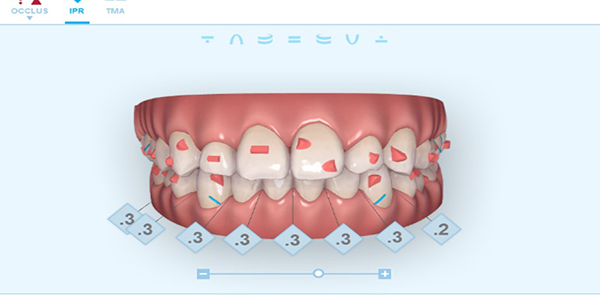 インビザラインのデメリット