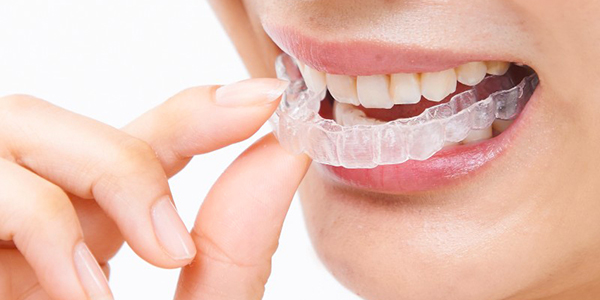 インビザラインのデメリット